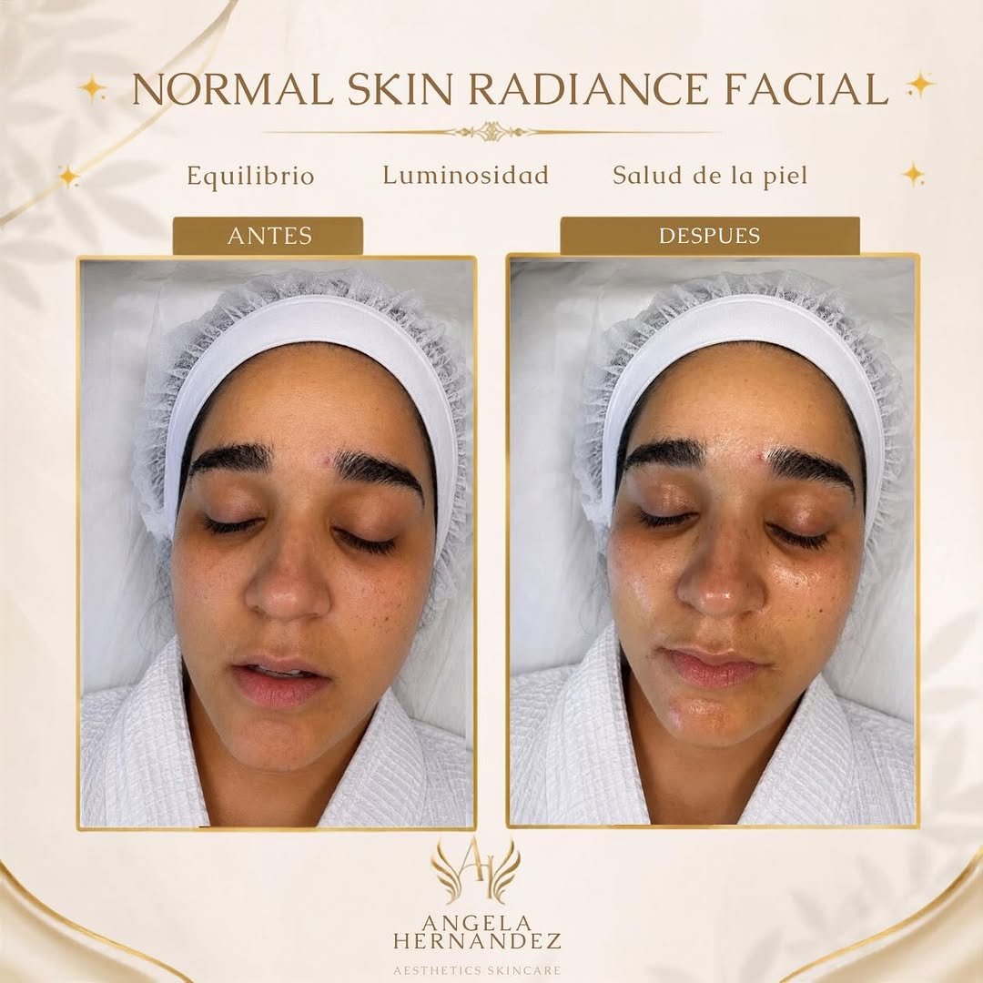 Normal Skin Radiance Facial result